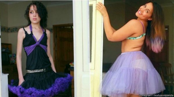Ex-anorxica de 30kg aos 15 anos expe curvas e faz campanha por corpos normais no Instagram; veja foto