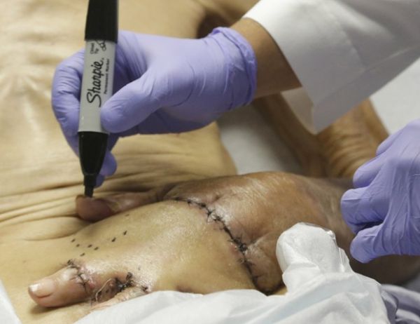 Cirurgio Anthony Echo marca pele de idoso durante preparao para separar mo do abdmen