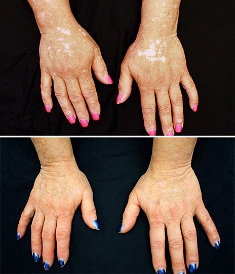 Imagem mostra as mos de paciente antes e depois do tratamento, que durou cerca de cinco meses. Medicamento ajudou a reduzir significativamente as manchas provocadas pelo vitiligo