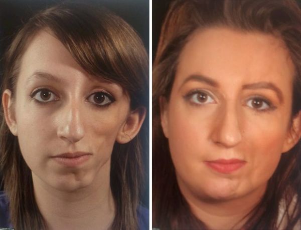 Britnica Yasmin Butler, de 22 anos, passou por vrias cirurgias para corrigir deformidade que fazia parecer que metade de seu rosto tinha 'derretido'