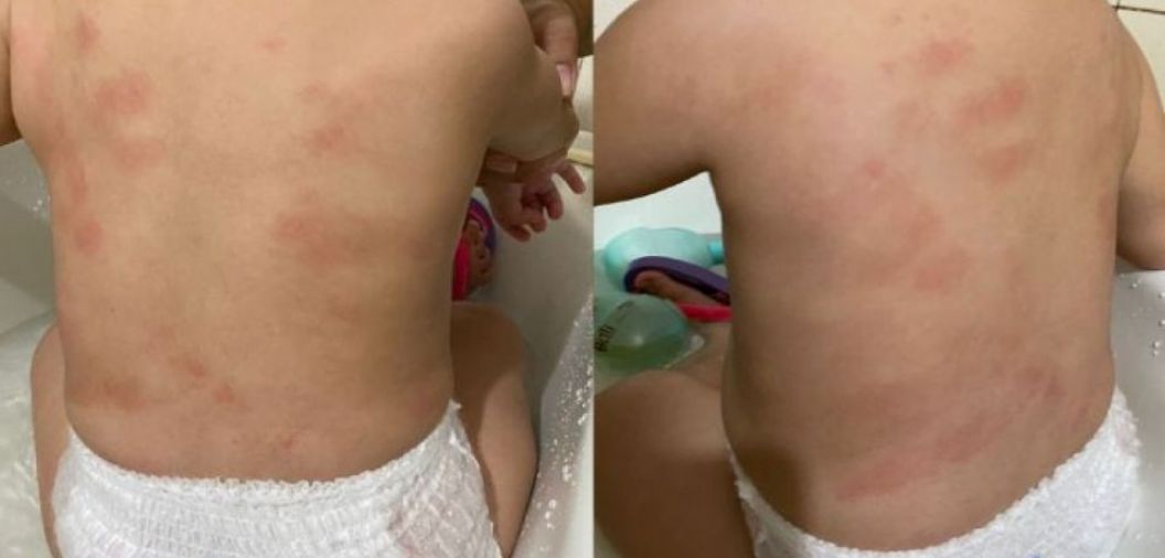 Me denuncia creche municipal aps encontrar vrios hematomas na filha de 1 ano