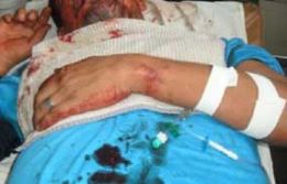 Bandido ferido durante assalto  ECT  transferido para Rondonpolis