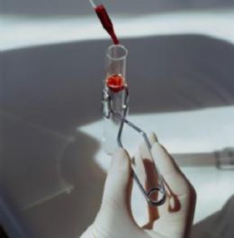 Exame gentico indica dosagem de anticoagulantes para pacientes