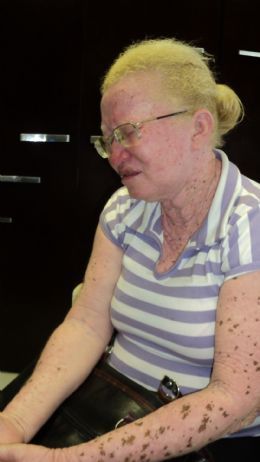 Servidoras tinham medo de que albina contaminasse pacientes