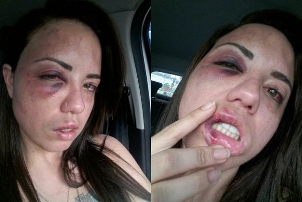Rondonopolitana denuncia ex-namorado por agresso e posta imagens no Facebook e Instagram