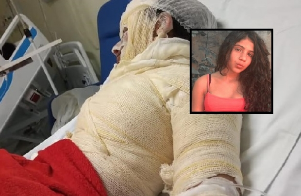 Adolescente sofre queimaduras de 2 grau em acidente com lcool em gel em Cuiab
