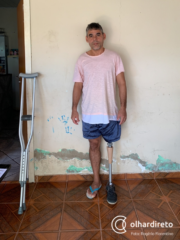 Gari que teve perna amputada recebe prtese da Prefeitura e dever passar por nova cirurgia