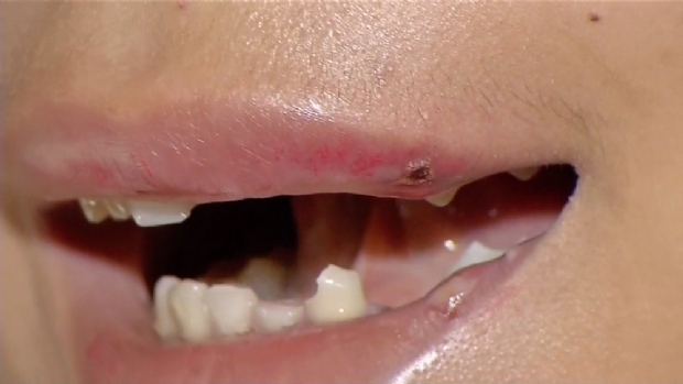 Travesti de 15 anos  espancada e tem oito dentes quebrados