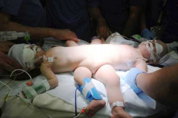 Cirurgia inovadora separa bebs siameses na Arbia Saudita