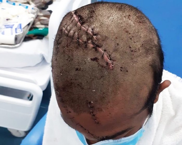 Indgena atacado por ona-pintada passa por cirurgia na cabea e segue internado; veja fotos