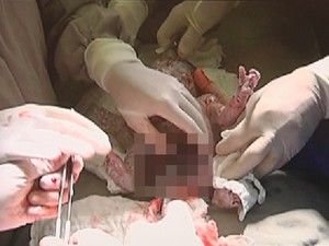 Hospital em Rio Preto realiza cirurgia indita no Brasil em recm-nascido