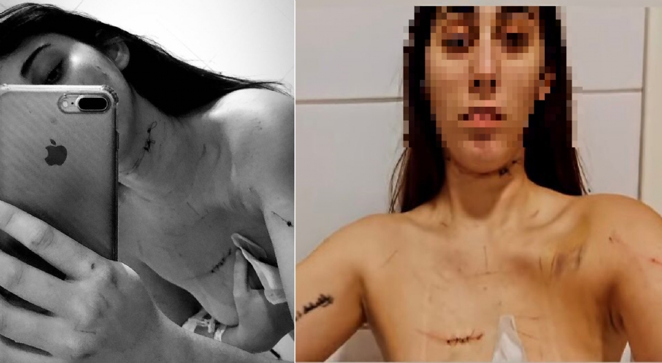 Mulher que denunciou jogador do Cuiabá mostra ferimentos no pescoço