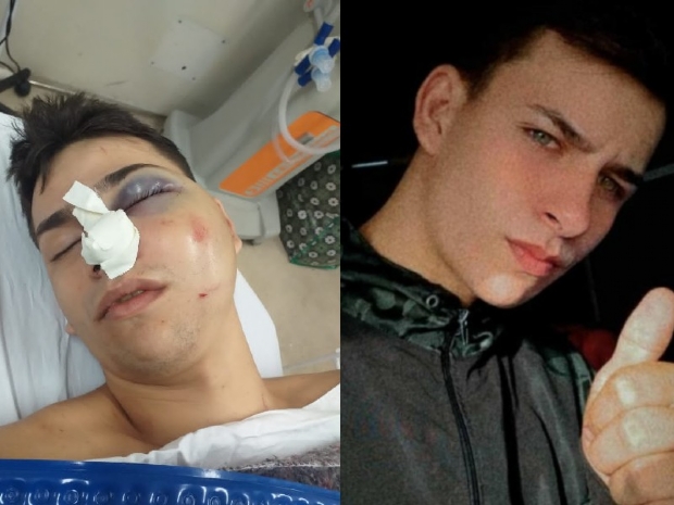 Entregador de 19 anos bate de frente em container durante trabalho e precisa de cirurgia para reconstruir face