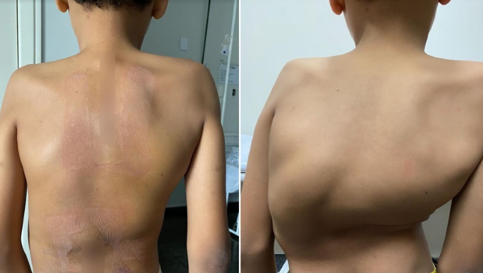 Menino de 11 anos passa por cirurgia rara para correção de escoliose em Cuiabá