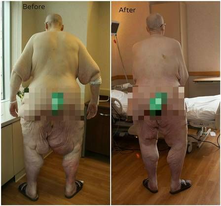 Ex-mais gordo do mundo divulga vdeo com os primeiros passos aps cirurgia