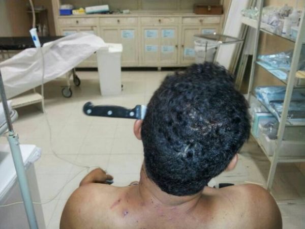 Homem de 40 anos fica com faca cravada na cabea aps discusso