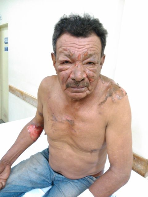 Homem  roubado e incendiado durante assalto em esquina