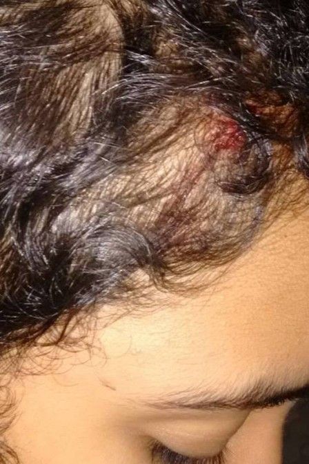 Vtima de intolerncia religiosa, menina de 11 anos  apedrejada na cabea aps festa de Candombl