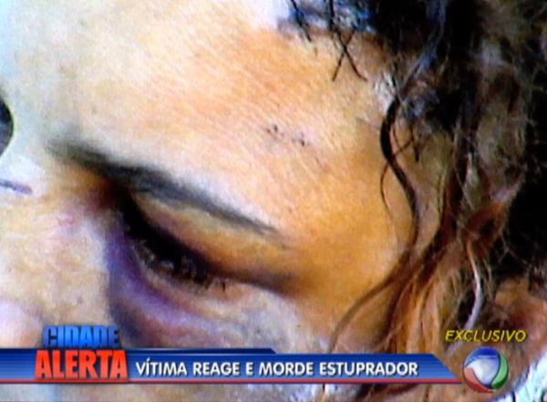 Mulher atacada pelo estuprador no matagal levou pontos no rosto
