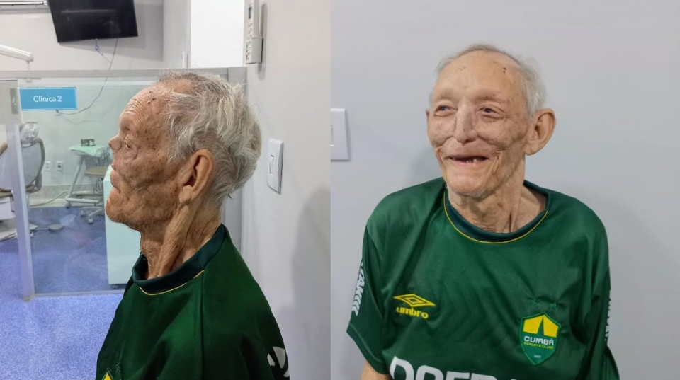 Paciente de 80 anos com câncer de pele recebe prótese de nariz