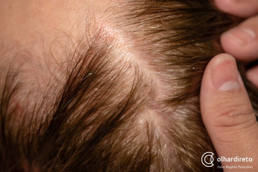 Infectologista alerta sobre queda de cabelo percebida em pessoas que se curaram da Covid-19