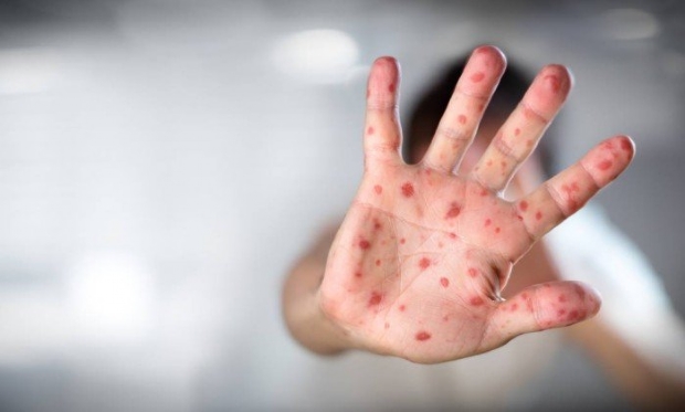 MT registra dois casos de sarampo aps 19 anos de erradicao e um de febre amarela