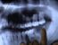 Dentista arranca todos os dentes de adolescente em Braslia