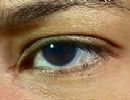Efeitos da polmica cirurgia para mudar a cor dos olhos