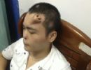 Cientistas chineses reproduzem nariz na testa de paciente